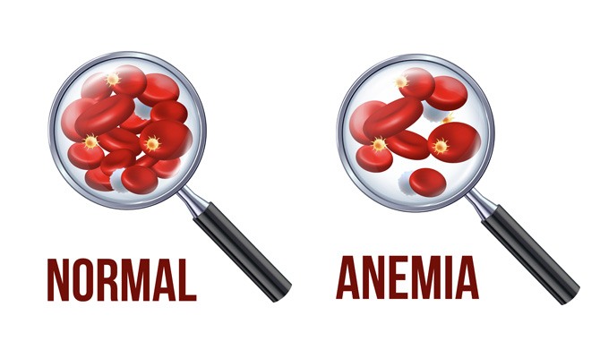 Anaemia during pregnancy Hospital in Meerut