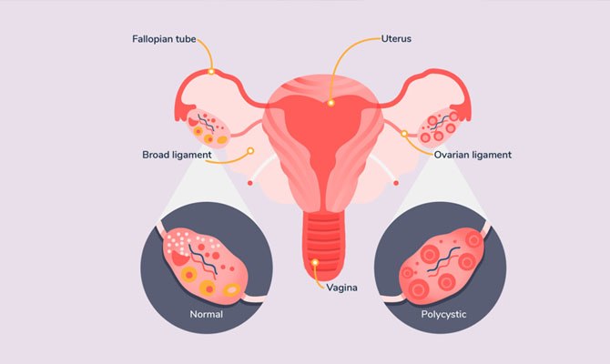 Polycystic Ovarian Syndrome Doctor in Meerut