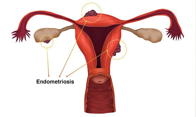 Endometriosis Doctor in Meerut